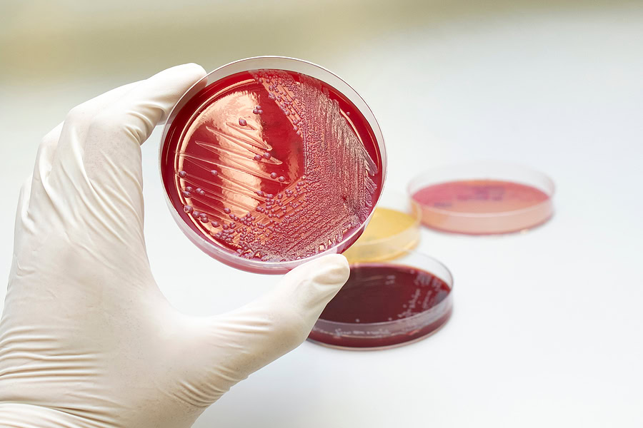 Hand holding petri dish with Escherichia coli (E. coli) culture in macconkey agar. Bacterium culture growth in glassware. Medical tests in laboratory.